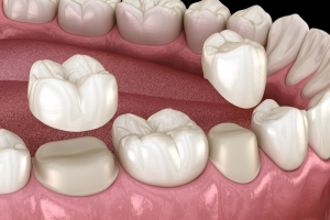Getting a Dental Crown: Things to Know  Getting a Dental Crown: Things to Know